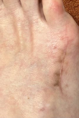 Narbenbehandlung Beispiel